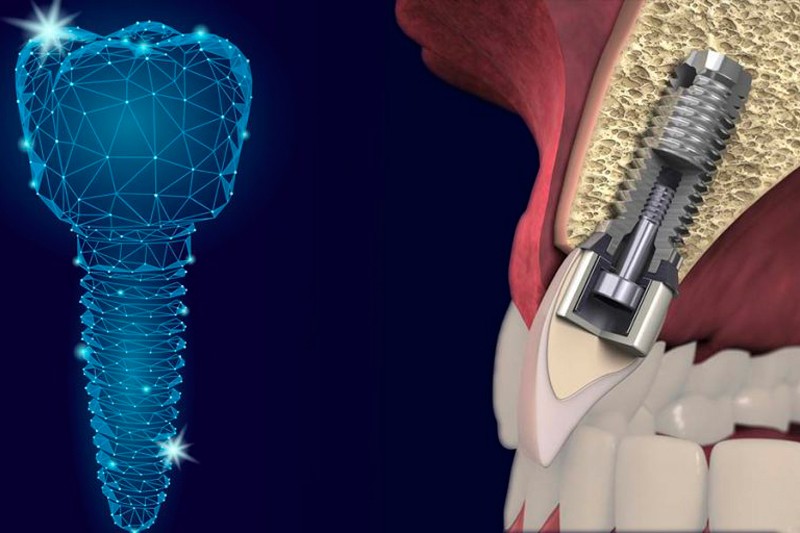 Injerto De Hueso Para Colocaci N De Implantes Dentales En Qu Consiste