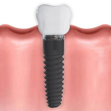 Implantes Dentales en Granada