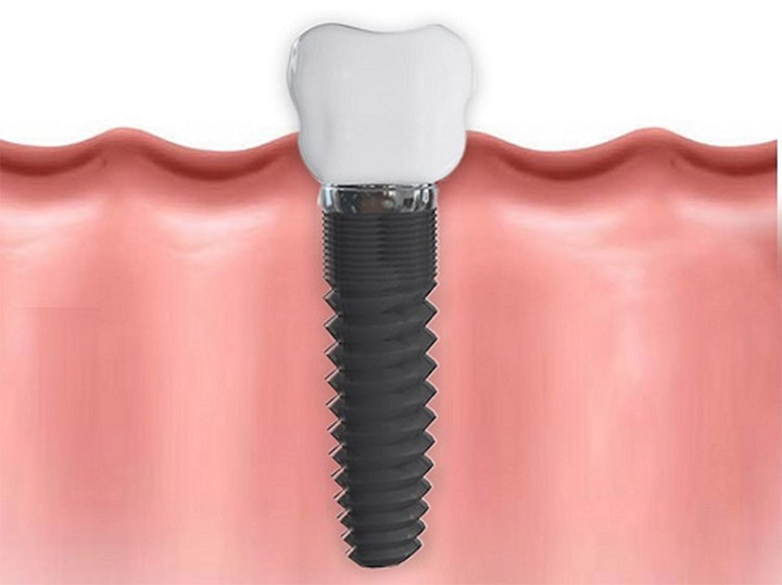 Implantes Dentales en Granada