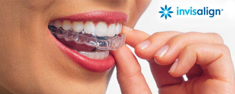 Invisalign Granada