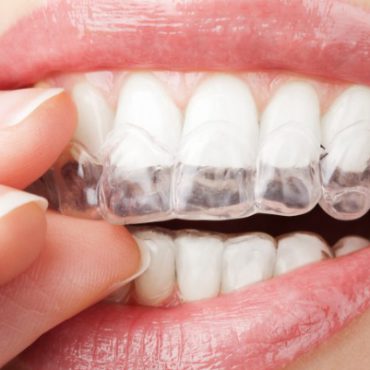 bruxismo clinica dental granada