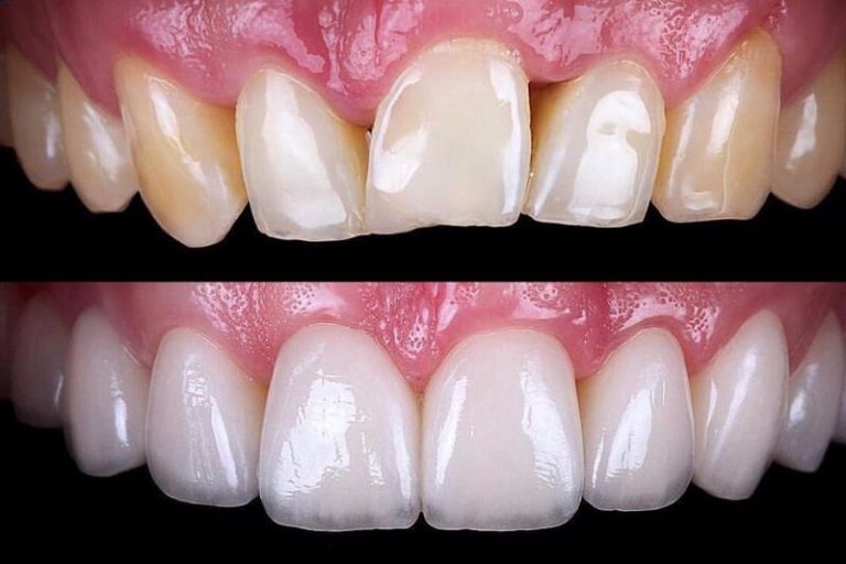 Carillas dentales de porcelana - Estética Dental | Ribera Clínica Dental