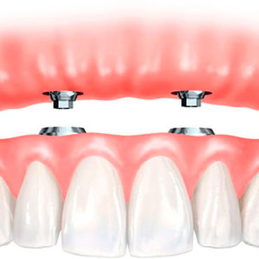 dentadura postiza Granada