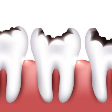 tratamiento caries clínica dental granada