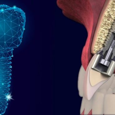 injerto de hueso para colocación de implantes dentales