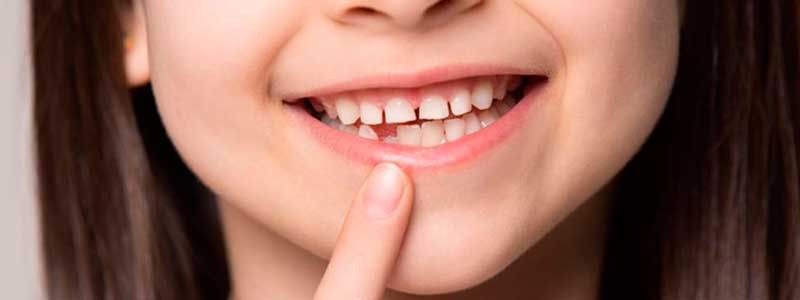 Cuándo Salen Y Se Caen Los Dientes De Leche | Ribera Clínica Dental