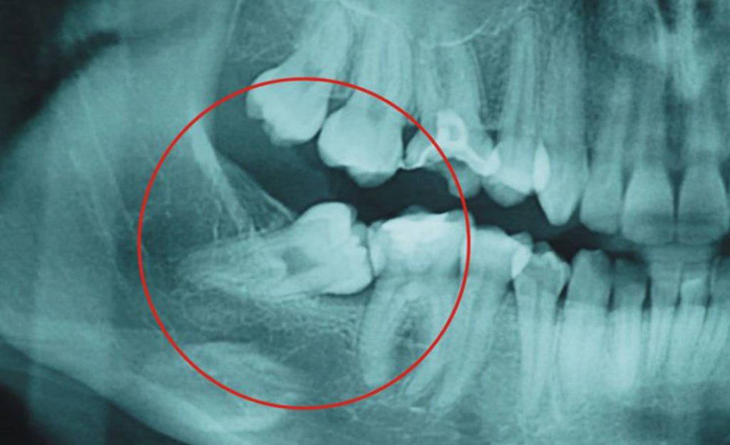 muelas del juicio cirugía oral granada clinica dental ribera