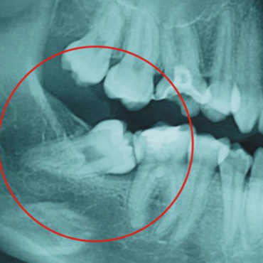 muelas del juicio cirugía oral granada clinica dental ribera