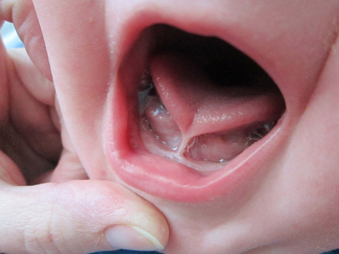 operar frenillo lingual clinica dental ribera granada