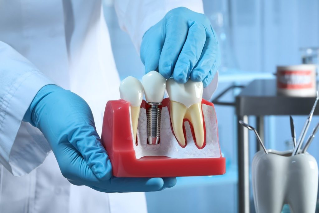 Implantes Dentales y Coronas de Circonio en Ribera Clínica Dental Ribera Clínica Dental